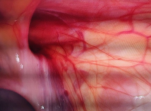 Cảnh giác với thoát vị bẹn ở trẻ em