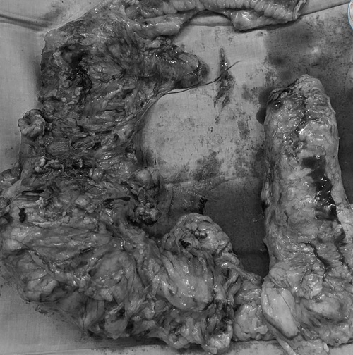 Hay đau bụng- Cảnh giác với ung thư đại tràng