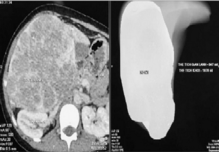 Viêm ruột thừa - một nguyên nhân gây đau bụng ở trẻ.