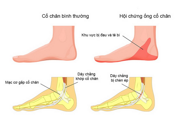 Chớ chủ quan với hội chứng đường hầm cổ chân