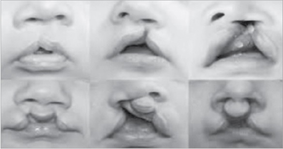 Phòng ngừa các dị tật bẩm sinh cho bé