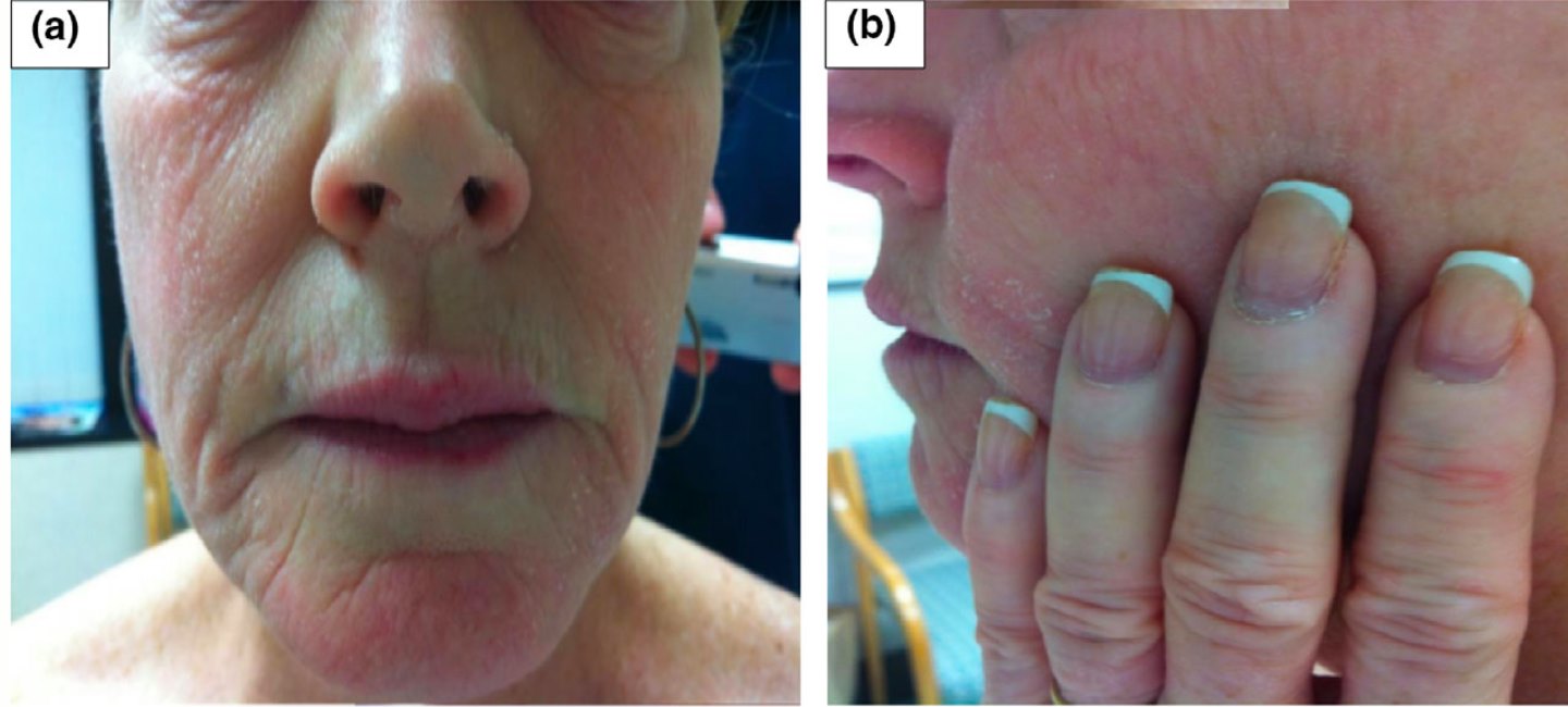 Viêm da tiếp xúc do sản phẩm chăm sóc móng tay