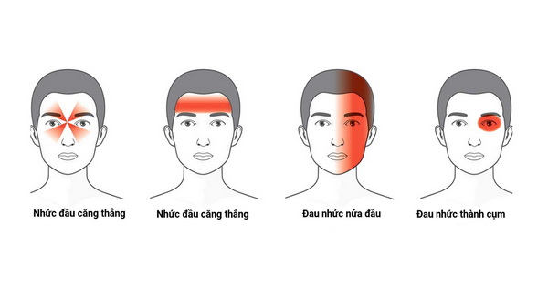 Đối phó với bệnh đau nửa đầu Migraine
