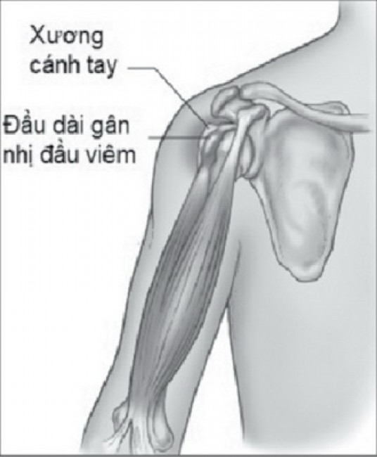 Tổn thương gân nhị đầu là 1 nguyên nhân gây viêm khớp vai.