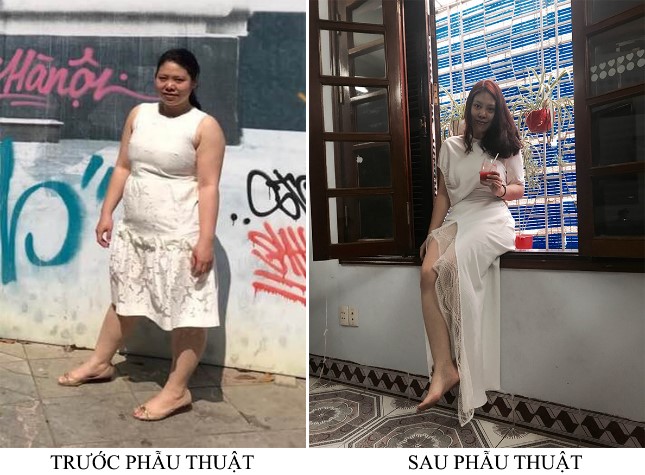 Phẫu thuật nội soi thu nhỏ dạ dày hình ống điều trị béo phì tại Bệnh viện TWQĐ 108