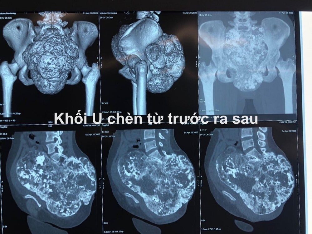 11 tiếng phẫu thuật thành công bệnh nhân có khối u xương cùng cụt kích thước khổng lồ