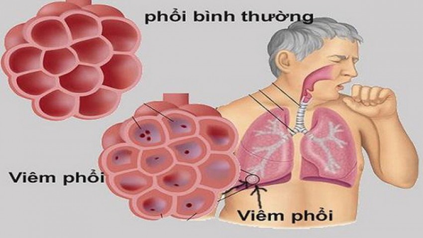 Viêm phổi nếu không phát hiện sớm dễ gây biến chứng nặng.
