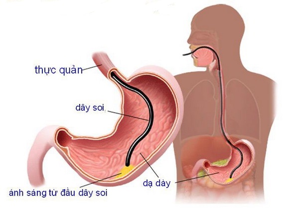 Nội soi dạ dày, những điều cần biết