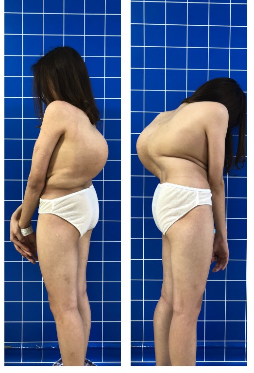 Sau một ca mổ cong vẹo cột sống