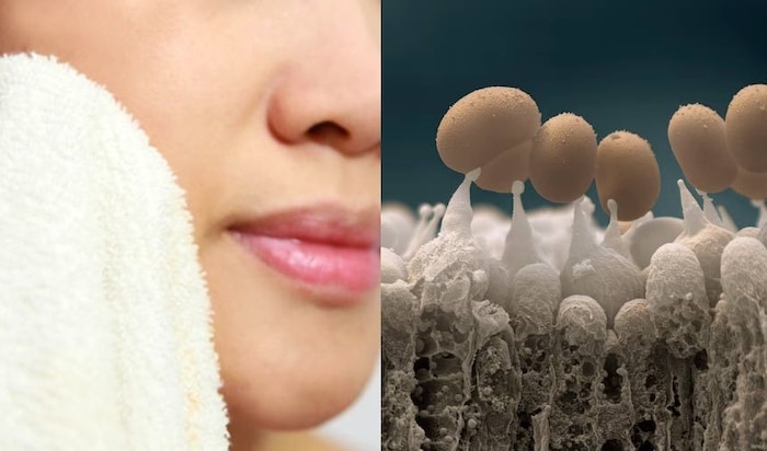 Mách bạn về nguyên nhân khiến da bạn mụn mãi không hết