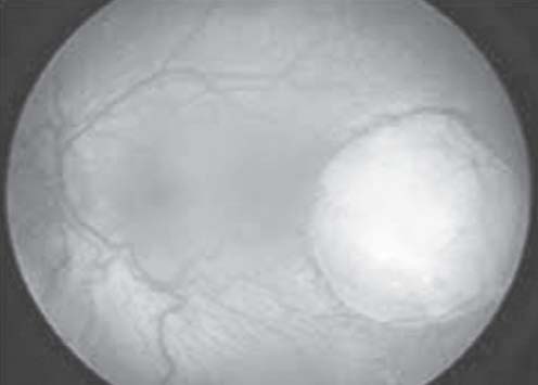 Phát hiện sớm u nguyên bào võng mạc