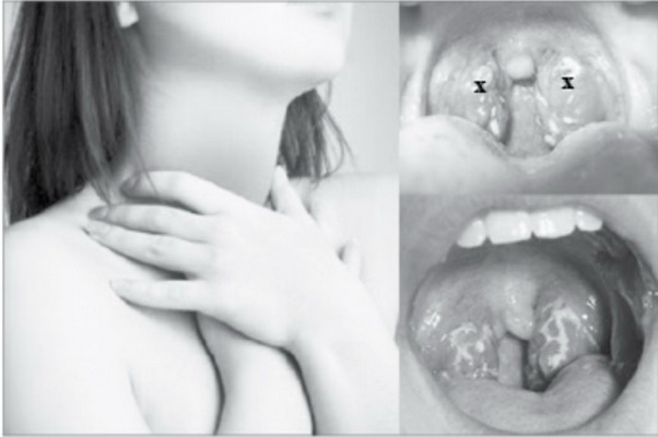 Viêm amidan, khi nào cần cắt?