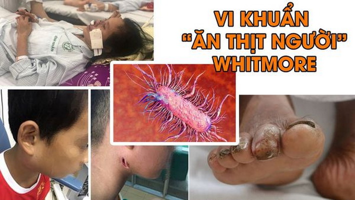 Cảnh giác với bệnh do vi khuẩn Whitmore gây ra sau lũ lụt