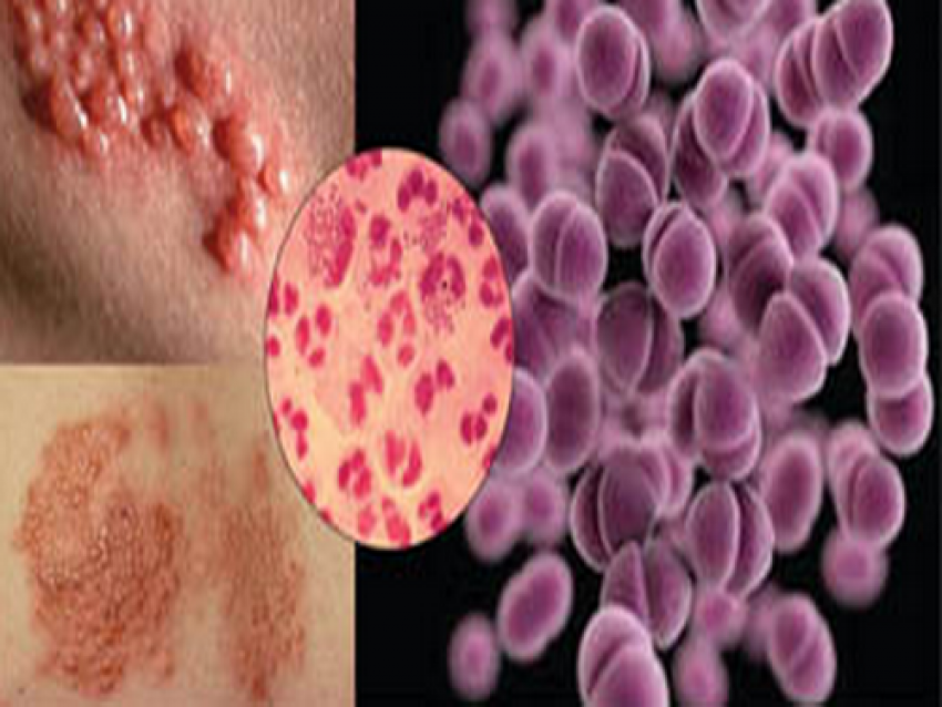 Hình ảnh vi khuẩn và biểu hiện bệnh lậu.