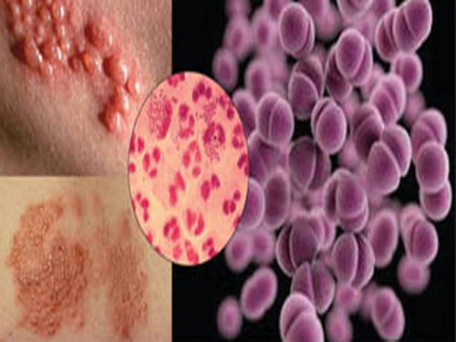 Biến chứng đáng ngại của bệnh lậu