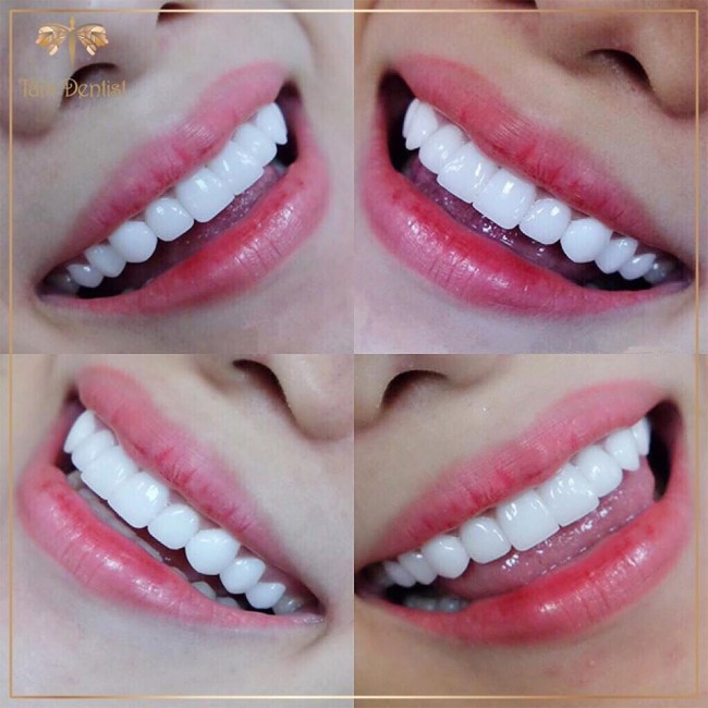 Răng sứ emax
