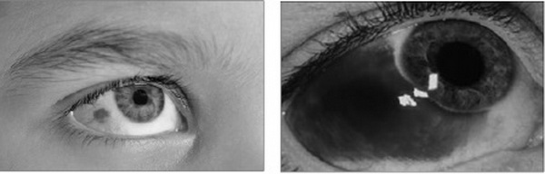 Xuất huyết dưới kết mạc có nguy hiểm?