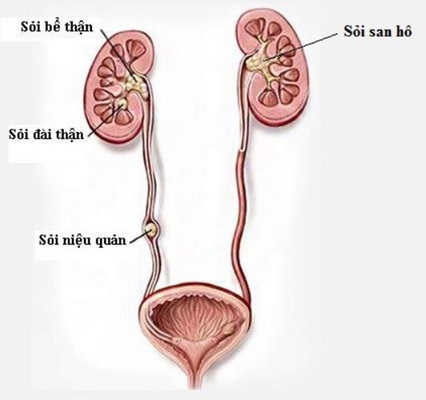 Biến chứng khó lường của sỏi niệu quản