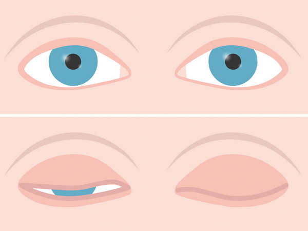 Khắc phục tình trạng hở mi mắt