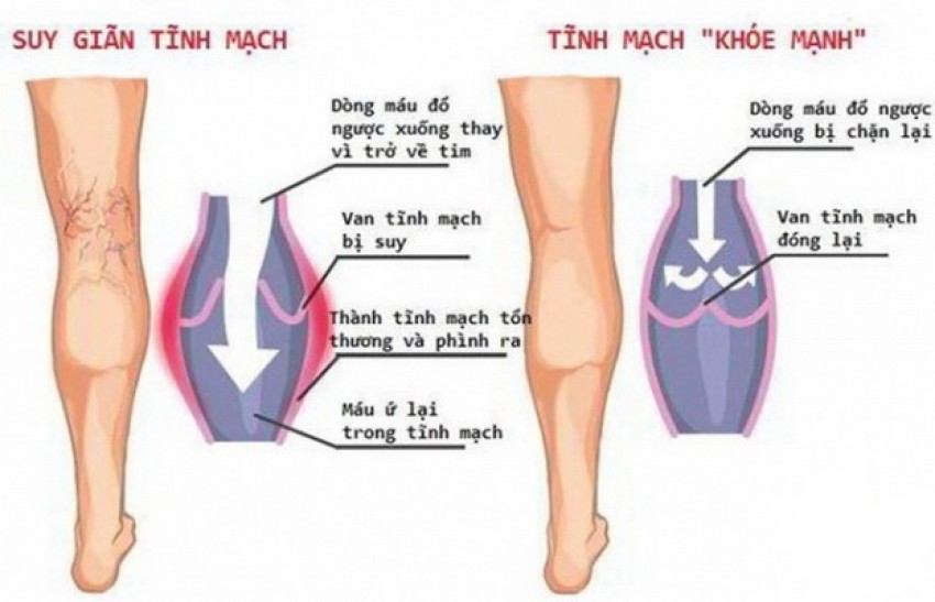 Hình ảnh suy giãn tĩnh mạch chi.