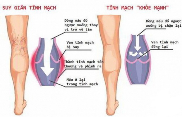 Hệ lụy do suy giãn tĩnh mạch
