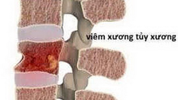 Viêm tủy xương và những biến chứng “để đời”