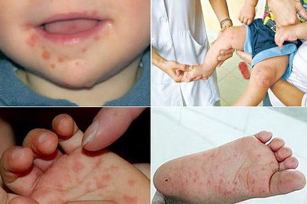 Bệnh tay chân miệng ở trẻ nhỏ: Khi nào cần nhập viện?