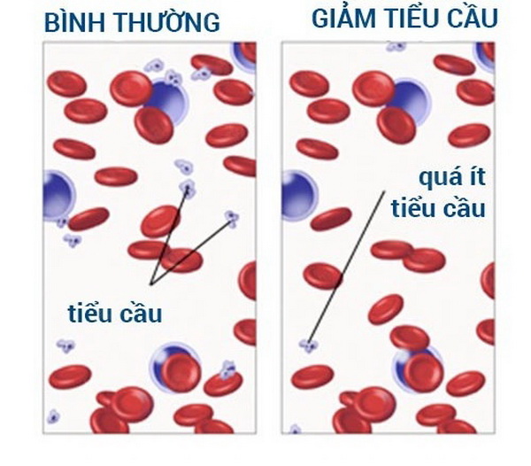Đề phòng biến chứng xuất huyết giảm tiểu cầu vô căn