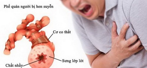 Chăm sóc bệnh nhân hen mắc bệnh tim mạch