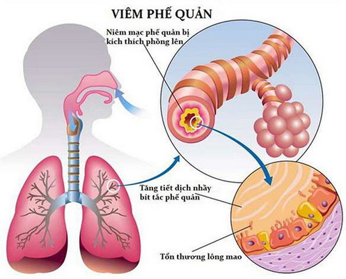 Phân biệt viêm phế quản do virus và vi khuẩn