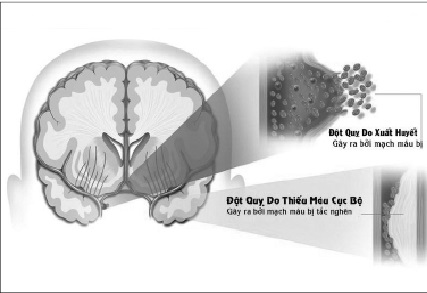 Thiểu năng tuần hoàn não: Sát thủ âm thầm gây đột quỵ