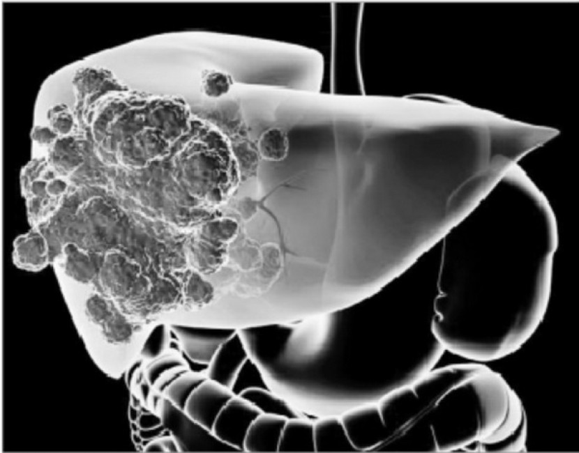 Cách cấp cứu người bị say nắng.