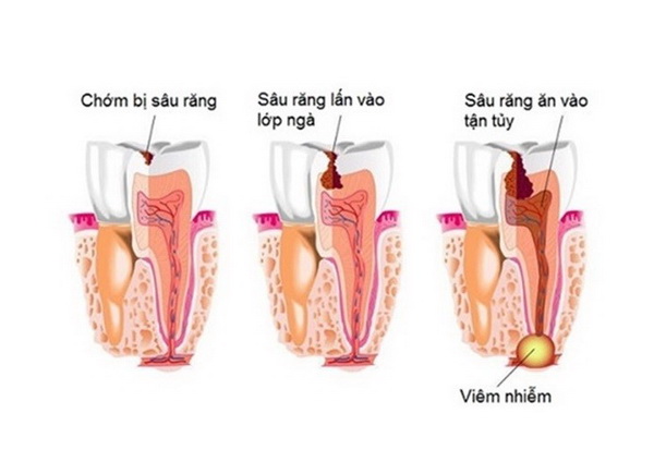Đề phòng biến chứng viêm xương tủy hàm