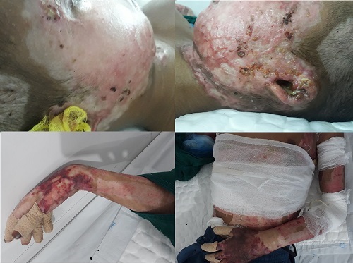 Mẹ tử vong, con bỏng nặng do đốt nương rẫy