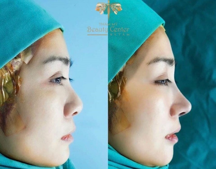 ai nên nâng mũi sline hàn quốc
