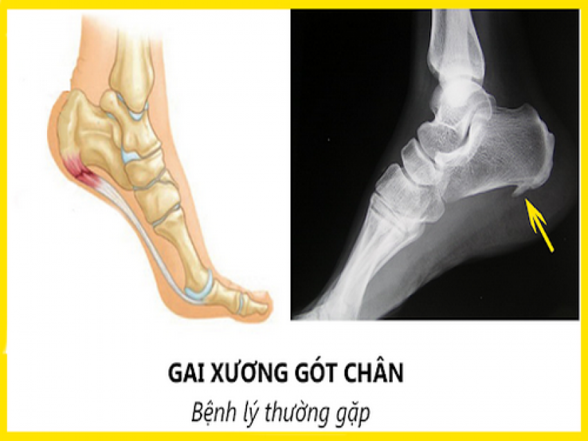 Hình ảnh gai xương gót chân.