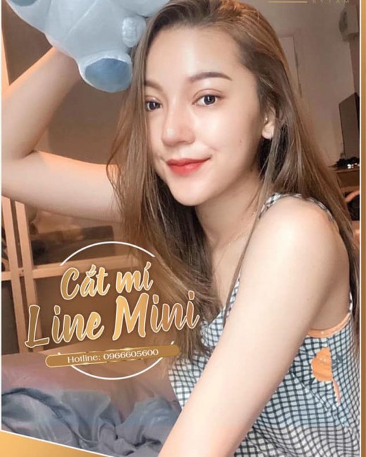 cắt mí