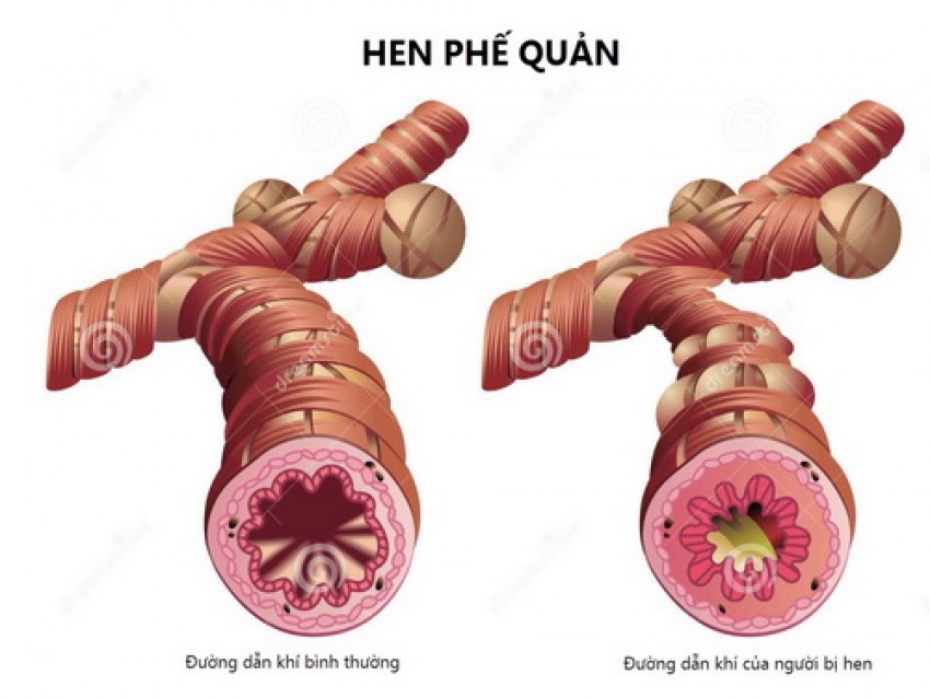 Bệnh hen và bệnh tim mạch là 2 bệnh mạn tính thường gặp ở người cao tuổi và triệu chứng của bệnh này có thể làm bệnh kia nặng thêm.