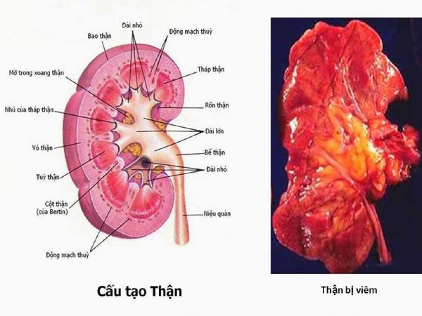 Viêm cầu thận cấp có thể gây biến chứng nguy hiểm.