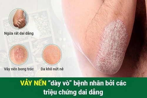 Kiểm soát và hạn chế tối đa biến chứng bệnh vẩy nến