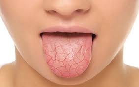 Đau rát miệng - Dấu hiệu không nên bỏ qua