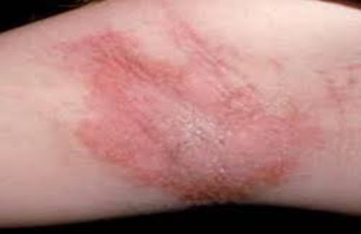 Ngập nước-Nguy cơ mắc bệnh về da