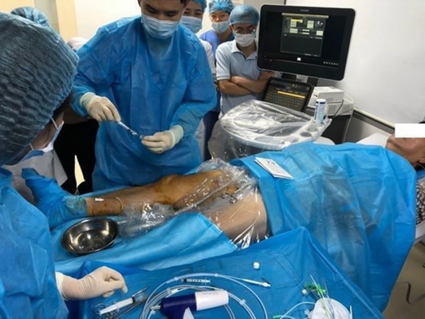 Điều trị cho bệnh nhân suy tĩnh mạch nông chi dưới bằng bơm keo sinh học.