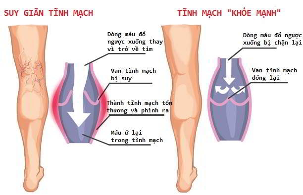 Cách tự chẩn đoán suy tĩnh mạch mạn tính