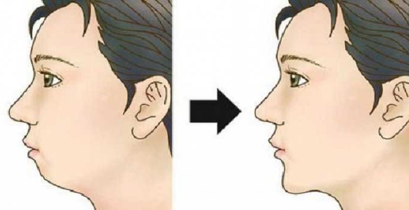 Cằm lẹm, môi chẻ là gì? Cách khắc phục cằm lẹm, môi chẻ