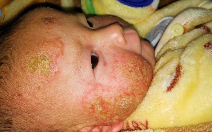 Căn bệnh rất hay gặp ở trẻ nhỏ 3 tháng sau sinh, cha mẹ cần cảnh giác