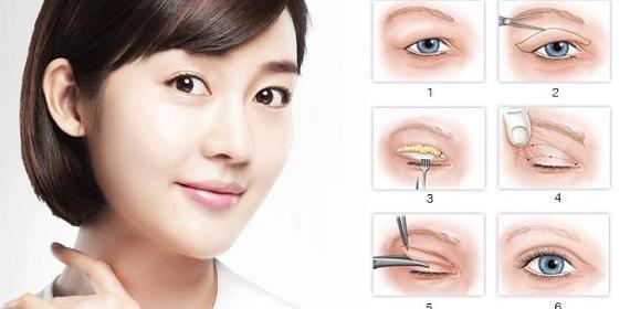 Cắt mí mắt là gì? Cách thực hiện và Chi phí