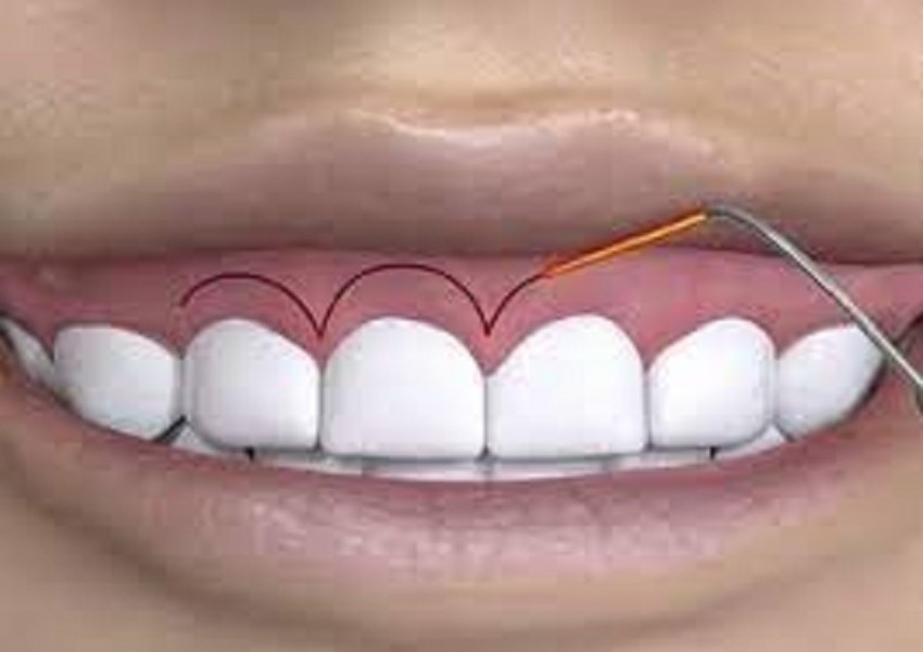phẫu thuật cắt nướu