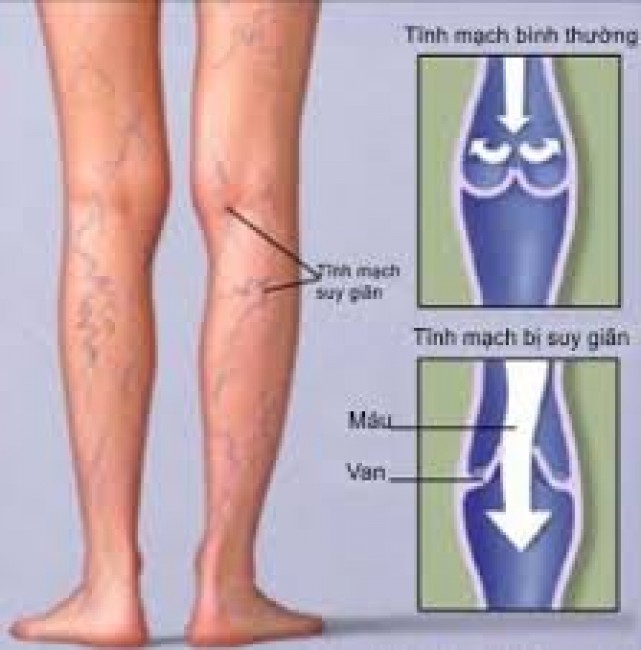 Nổi gân xanh trên cơ thể