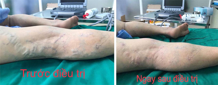 Suy giãn tĩnh mạch chi dưới là gì?